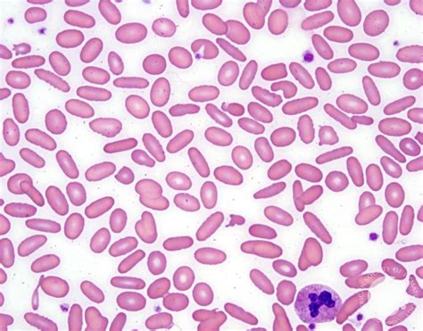 The Life Span of the Elliptocyte .